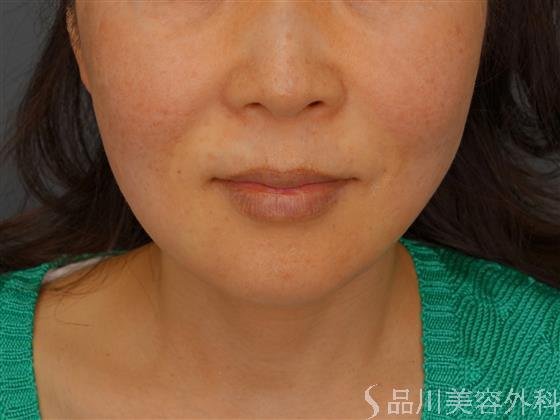 症例NO.60117のAFTER写真
