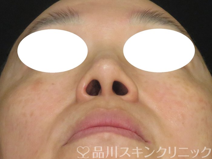 症例NO.70136のBEFORE写真