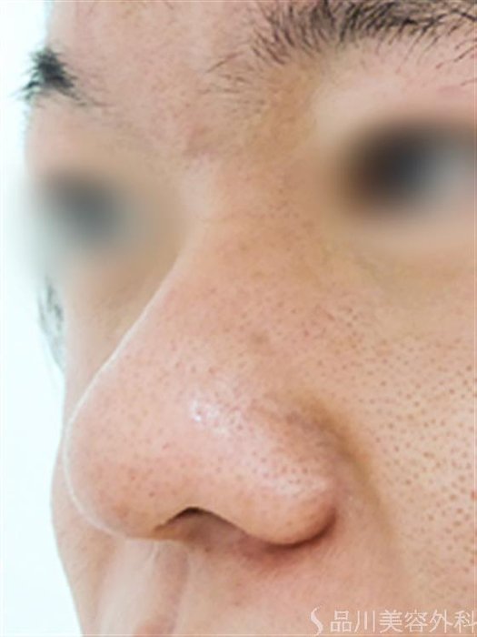 症例NO.23298のBEFORE写真