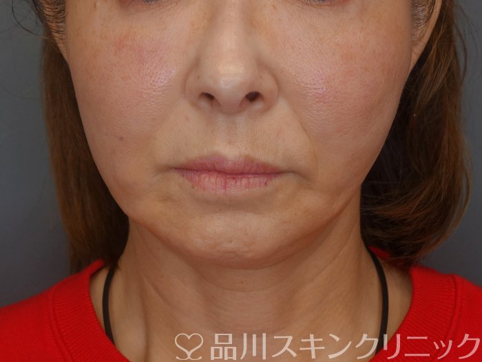 症例NO.74702のAFTER写真