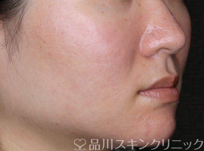 症例NO.64552のAFTER写真