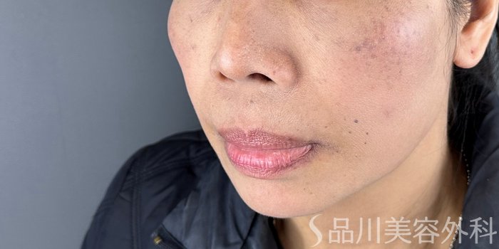 症例NO.69505のAFTER写真