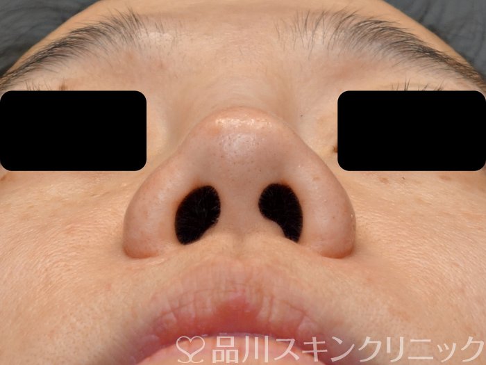 症例NO.72366のBEFORE写真