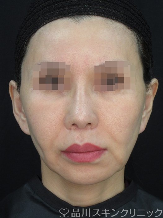 症例NO.74073のBEFORE写真