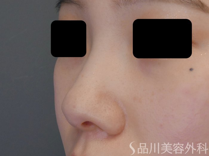 症例NO.69601のBEFORE写真