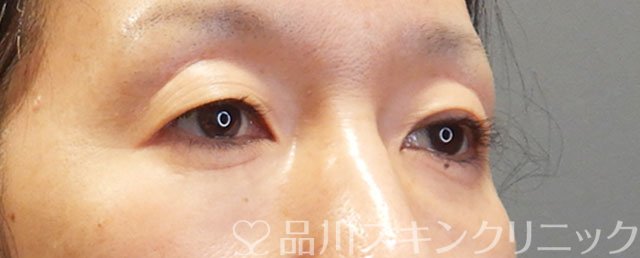 症例NO.75243のBEFORE写真