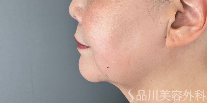 症例NO.71783のAFTER写真