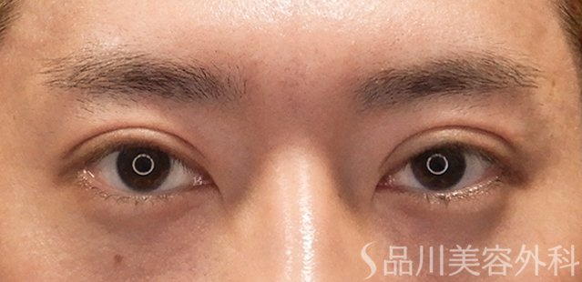 症例NO.72590のAFTER写真