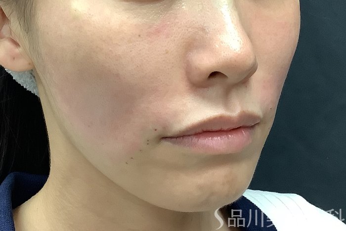 症例NO.71531のAFTER写真