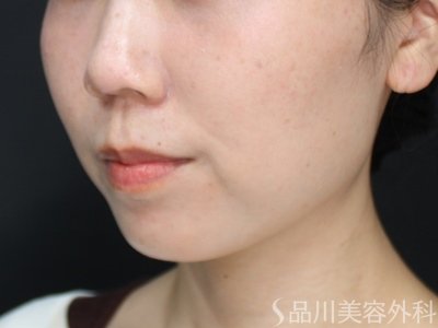 症例NO.75156のAFTER写真