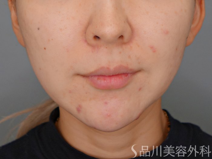 症例NO.70465のBEFORE写真