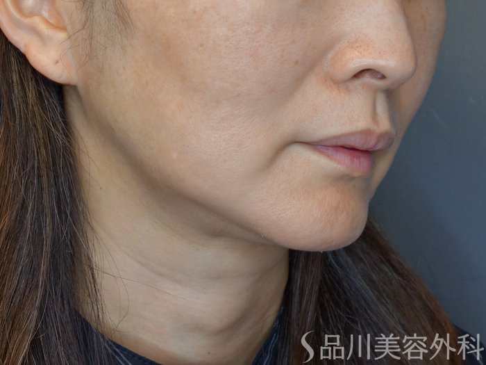 症例NO.72079のBEFORE写真