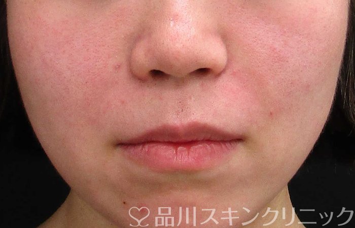 症例NO.68401のAFTER写真