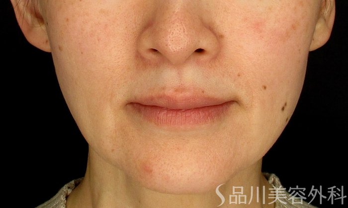 症例NO.73844のBEFORE写真