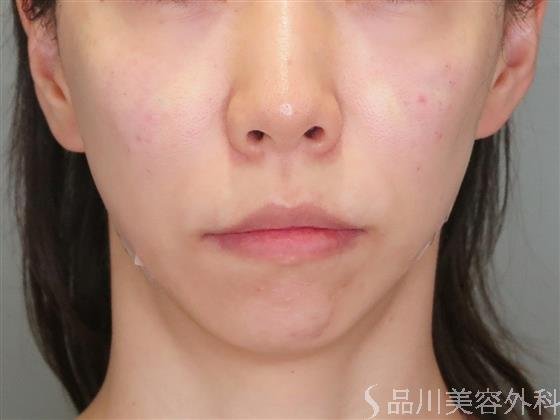症例NO.49164のAFTER写真