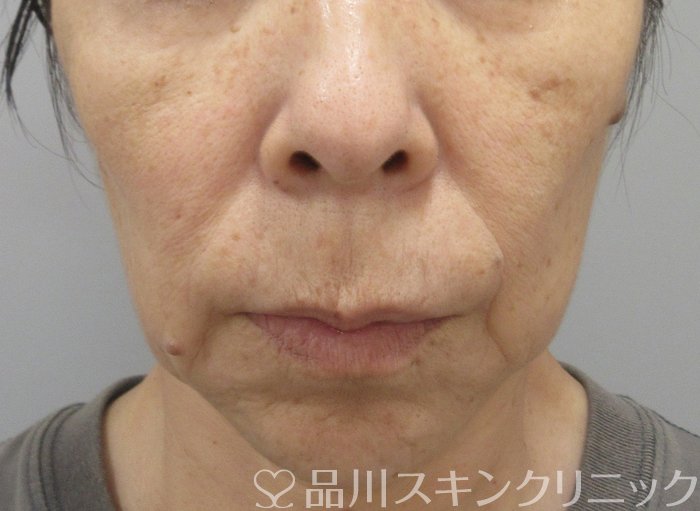 症例NO.73833のBEFORE写真
