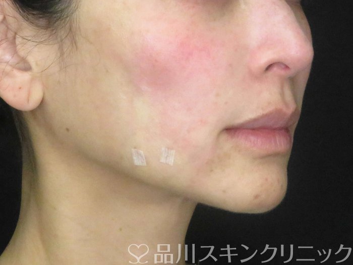 症例NO.67010のAFTER写真