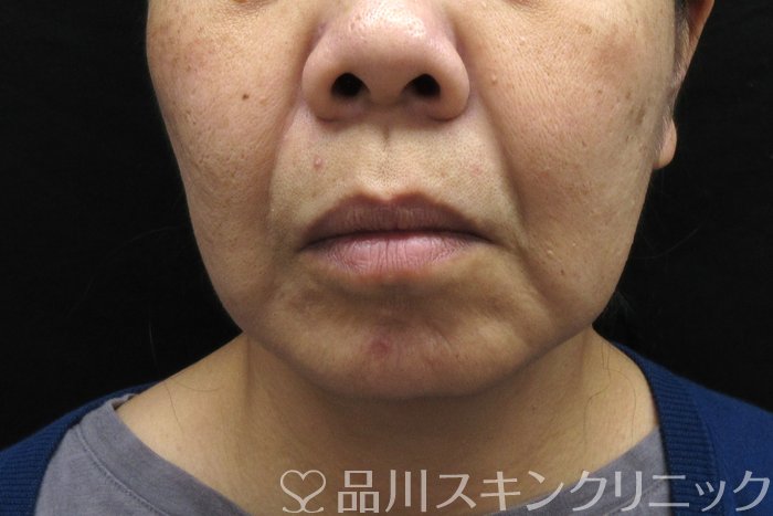 症例NO.74660のBEFORE写真