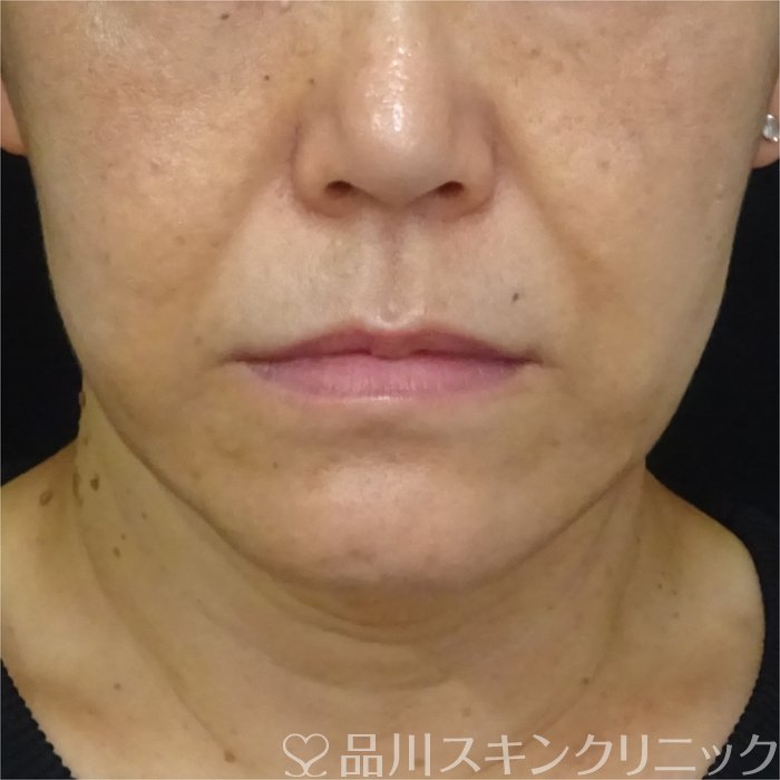 症例NO.69323のBEFORE写真