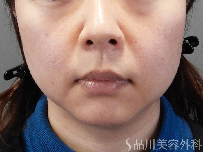 症例NO.69445のBEFORE写真