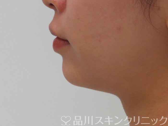 症例NO.65772のAFTER写真