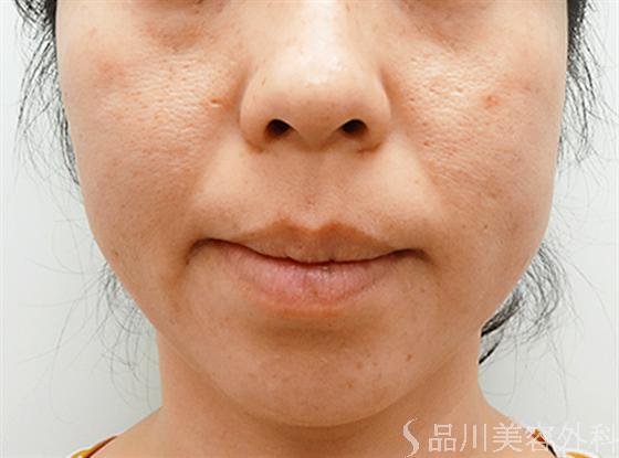 症例NO.13780のBEFORE写真