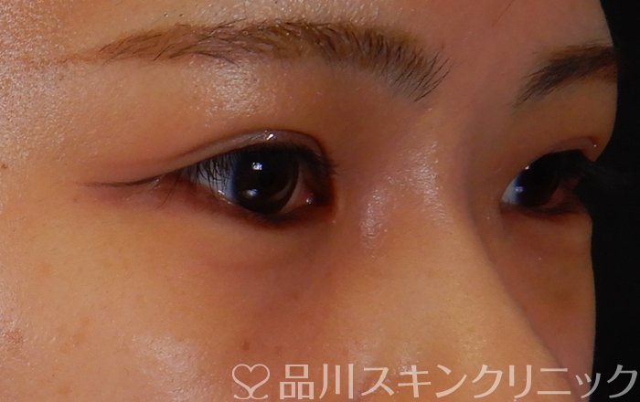 症例NO.66516のAFTER写真