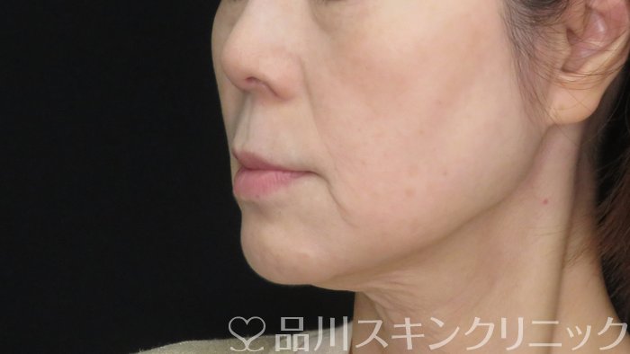 症例NO.72886のBEFORE写真