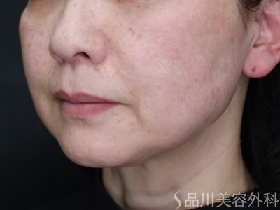 症例NO.74149のBEFORE写真