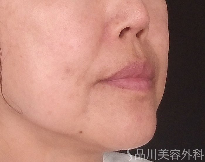 症例NO.70666のBEFORE写真