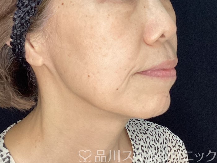 症例NO.71969のBEFORE写真