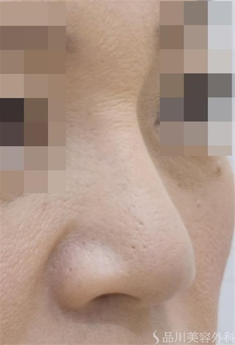 症例NO.48540のAFTER写真