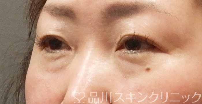 症例NO.63952のBEFORE写真