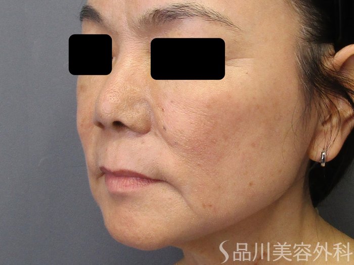 症例NO.74968のBEFORE写真