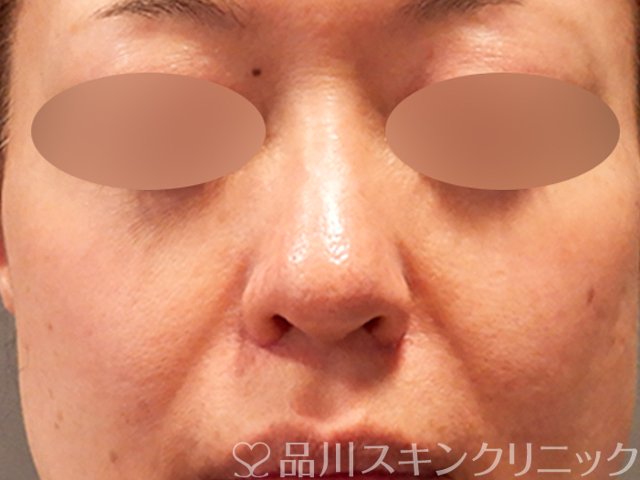 症例NO.69576のAFTER写真