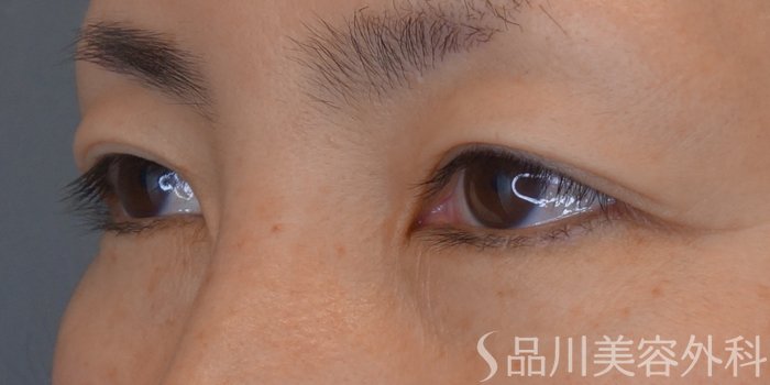 症例NO.68228のBEFORE写真