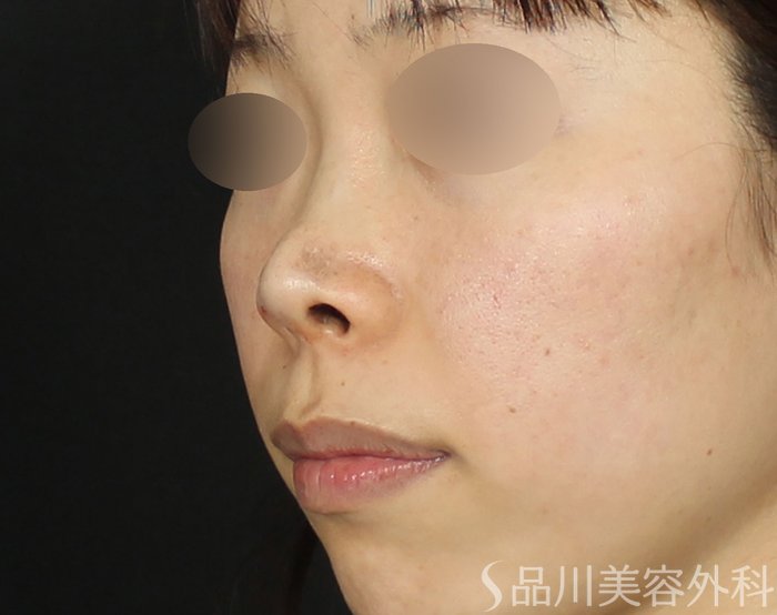 症例NO.72106のAFTER写真