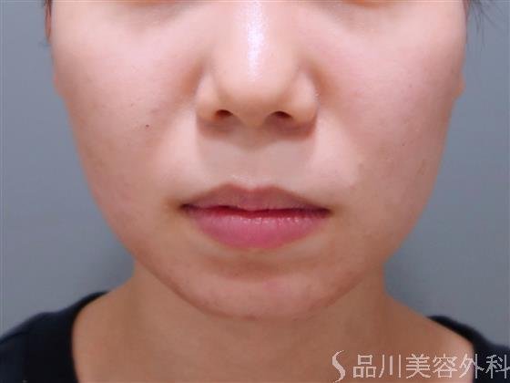 症例NO.51315のBEFORE写真