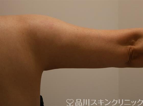 症例NO.43403のAFTER写真