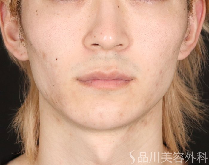 症例NO.73903のBEFORE写真
