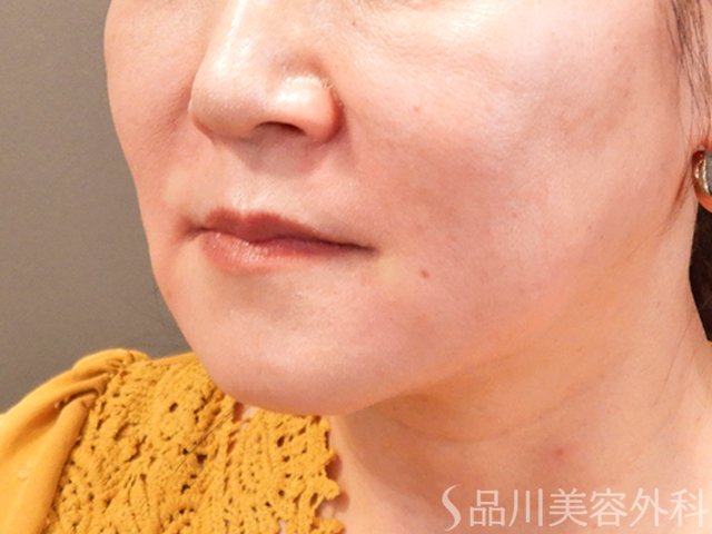 症例NO.70073のAFTER写真