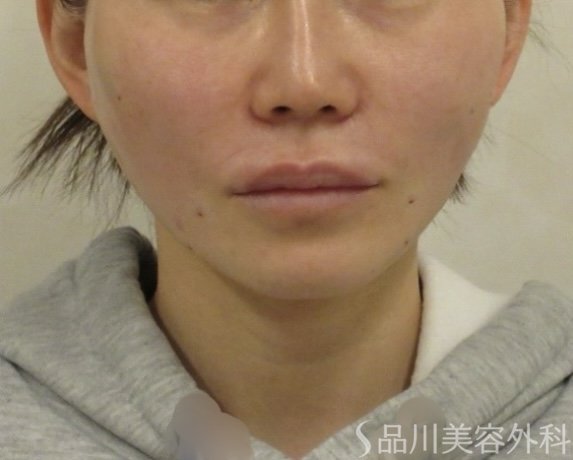 症例NO.73553のAFTER写真