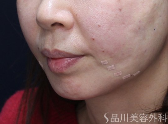 症例NO.73442のAFTER写真