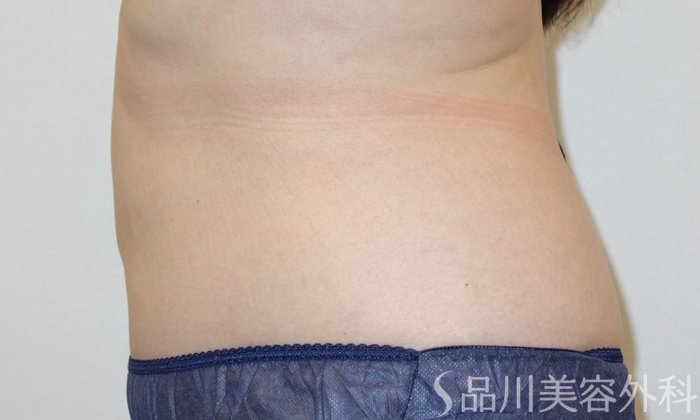 症例NO.72993のAFTER写真