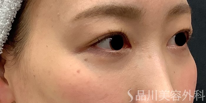 症例NO.69662のAFTER写真