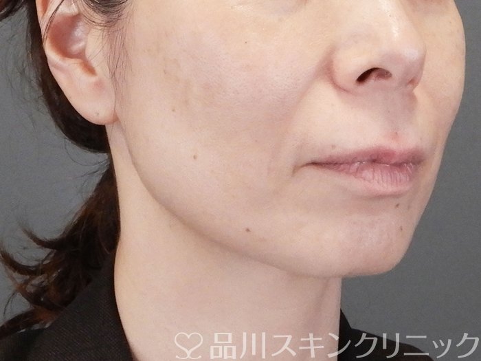 症例NO.75271のBEFORE写真