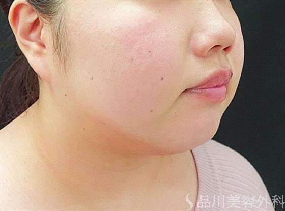症例NO.40591のAFTER写真