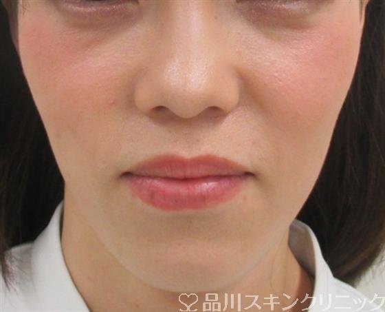 症例NO.29709のBEFORE写真