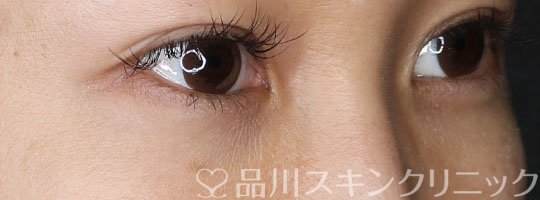 症例NO.70053のAFTER写真