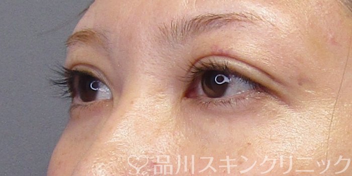 症例NO.75023のAFTER写真